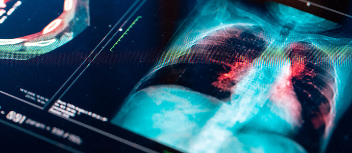 medical x ray of the lungs