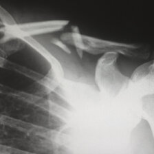x ray of a broken clavicle
