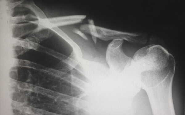 x ray of a broken clavicle